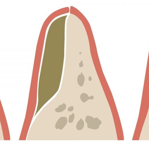 Dental-Bone-Loss-1200x480