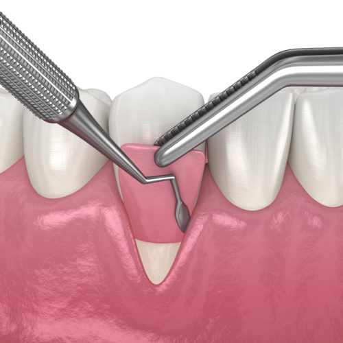 Gum Recession: Soft tissue graft surgery. 3D illustration of Dental  treatment